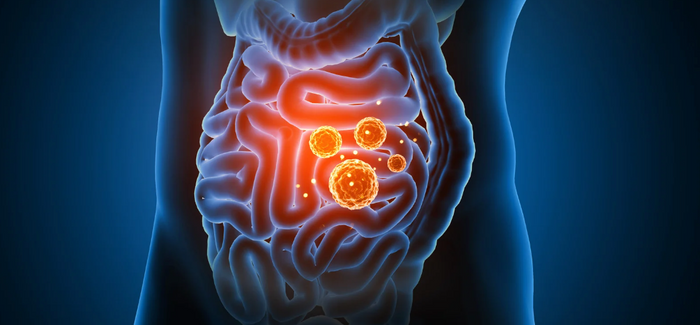 Managing Small Intestinal Bacterial Overgrowth (SIBO)