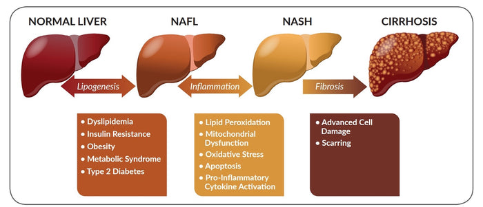 Nonalcoholic fatty liver disease